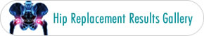 Knee Replacement Results Gallery