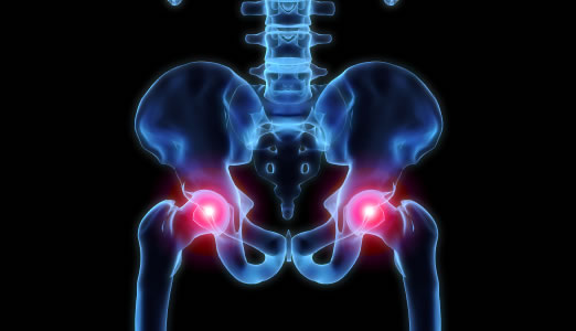 Hip Replacement