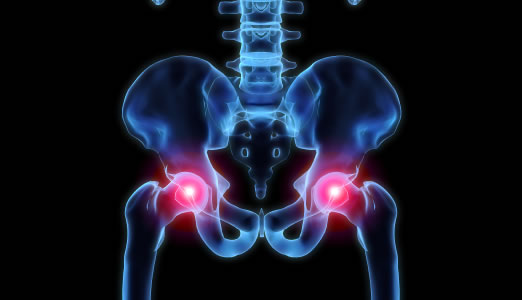 Hip Replacement