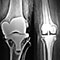 Total Hip Replacement